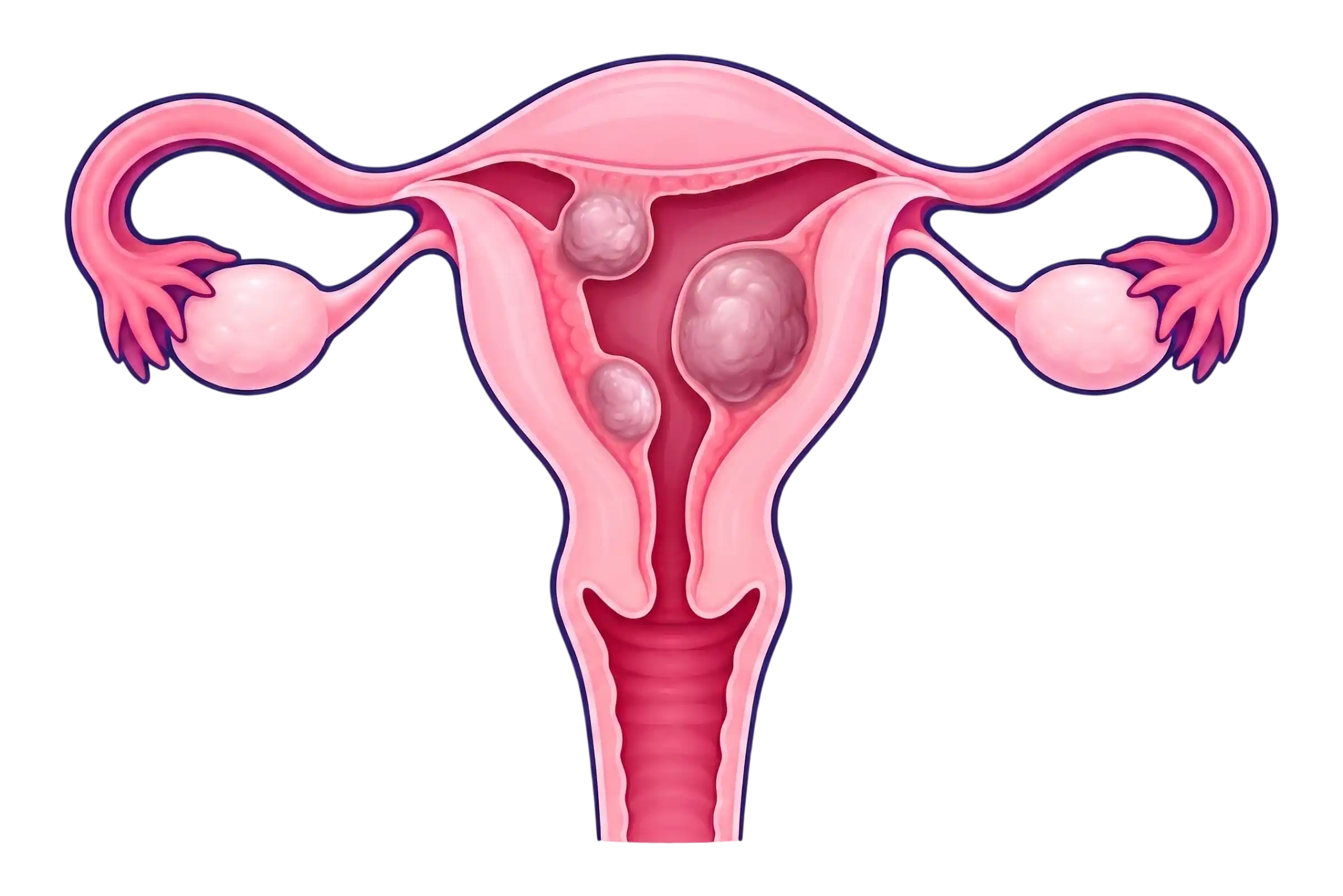 Miomas submucosos